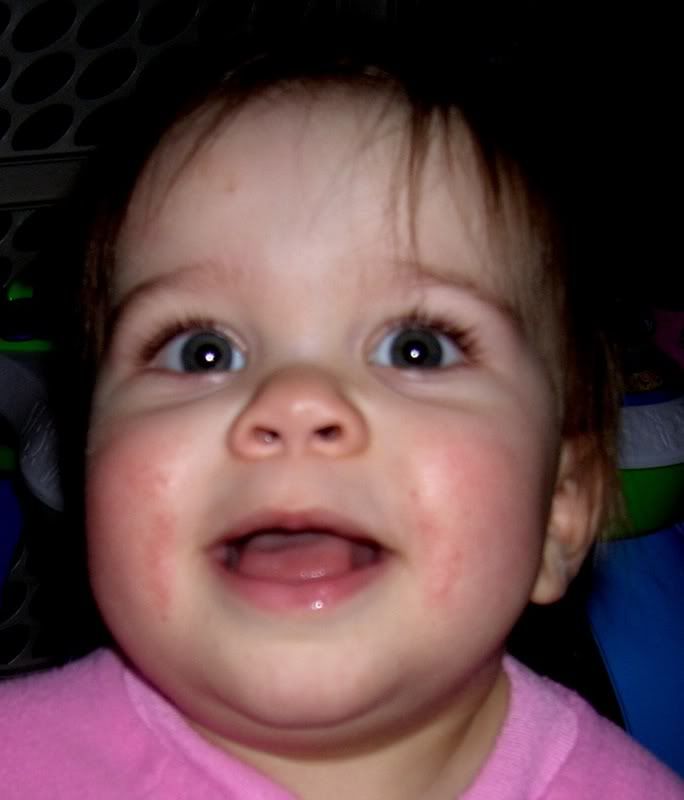 The rash isn#39;t that bad right teething rash on face pictures. The rash isn#39;t that bad right